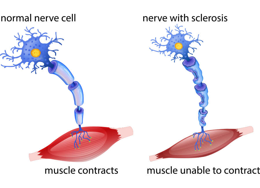 干细胞治疗渐冻症（肌肉萎缩），ALS