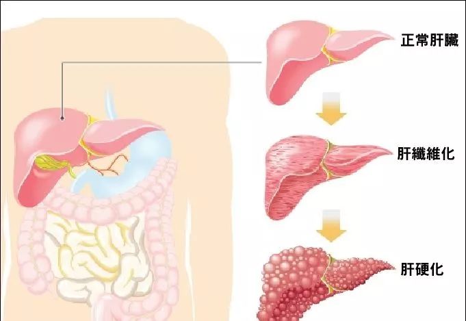 干细胞治疗肝功能障碍、肝硬化